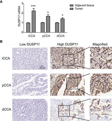 Dual-Specificity Phosphatase 11 Is a Prognostic Biomarker of Intrahepatic Cholangiocarcinoma